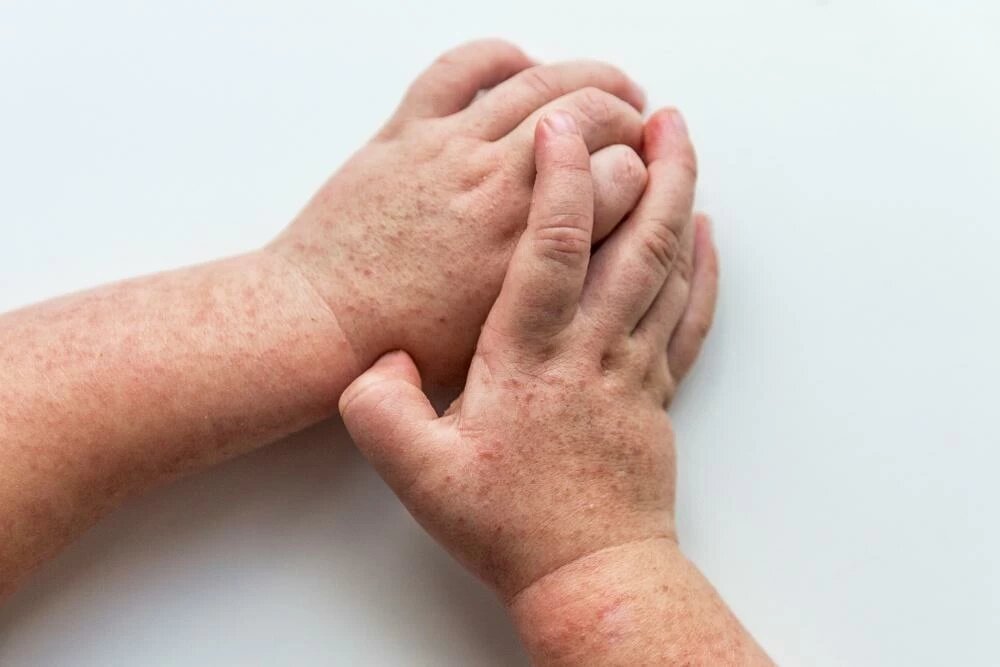 Желтые пятна на коже ребенка