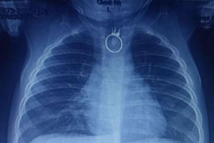 Лікарі врятували хлопчика, що проковтнув перстень