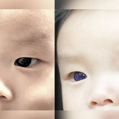 Изменение цвета глаз после препаратов COVID-19