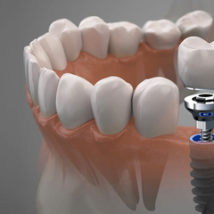 Dental Implantation in Ivano-Frankivsk: Everything You Need to Know