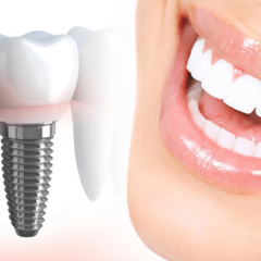 Почему не надо тянуть время с имплантацией зубов?