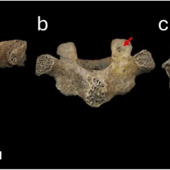 Spinal deformities on children's skeletons