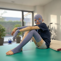 Children with burns undergoing rehabilitation