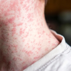 Американці не довіряють адміністрації Трампа у боротьбі зі спалахом кору