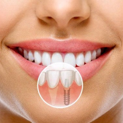 Что представляет собой установка имплантов в современных реалиях