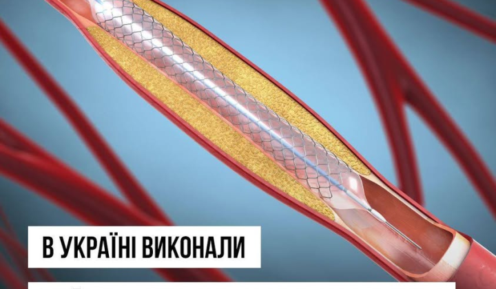 Бесплатное стентирование коронарных сосудов