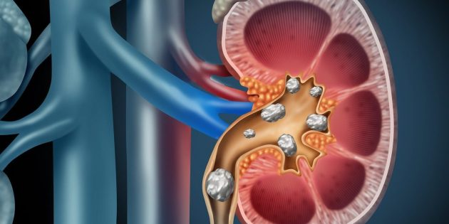 Причины образования камней в почках