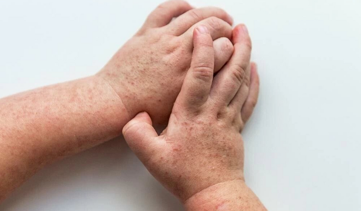 Жовті плями на  шкірі дитини