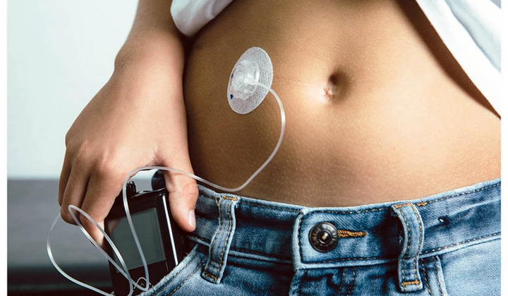 What is an insulin pump and who should pay attention to this diabetes gadget?