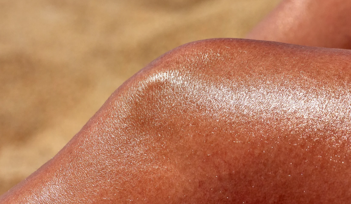Child with sunburn