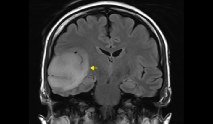 MRI brain tumor diagnosis proved to be more accurate