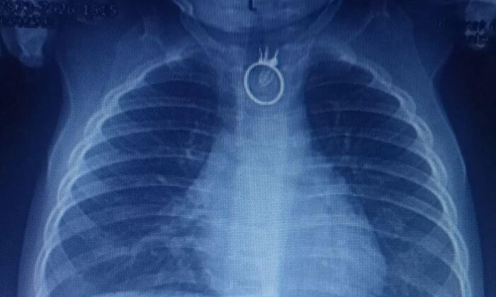 Лікарі врятували хлопчика, що проковтнув перстень