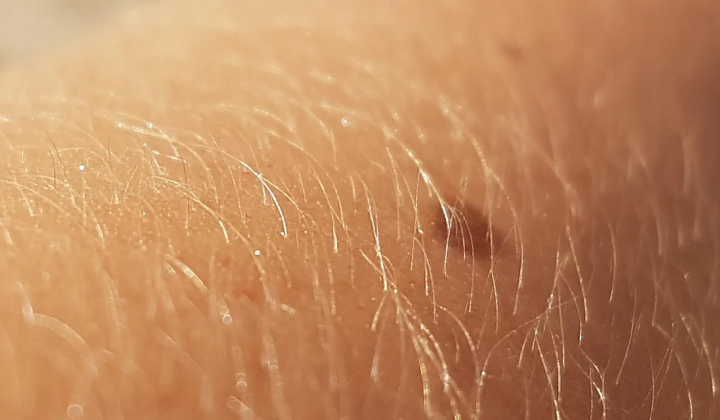 Personalized mRNA Vaccine Cuts Melanoma Recurrence Risk by 42% in Phase 3 Trial Results