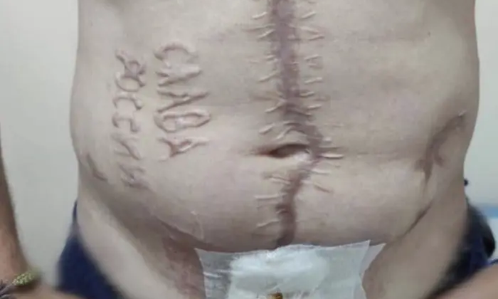 Выпаленный напис 'Слава России' на теле защитника