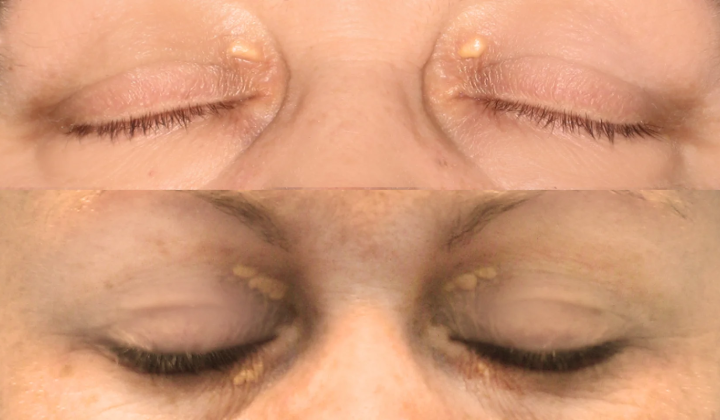 Image of xanthelasma on eyelids