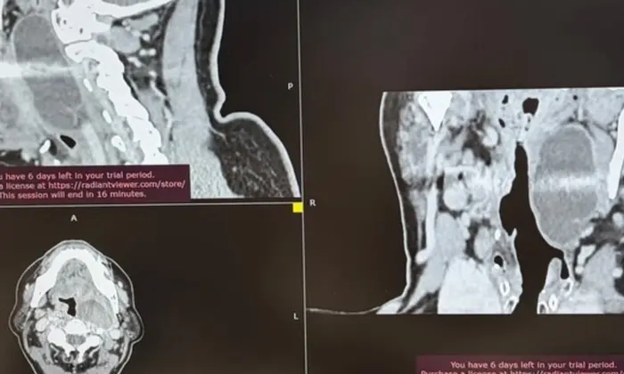 Patient undergoing surgery for rare tumor