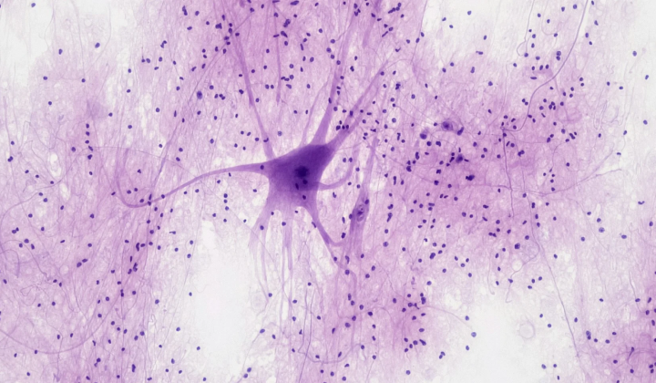 T-cells causing brain damage in Alzheimer's