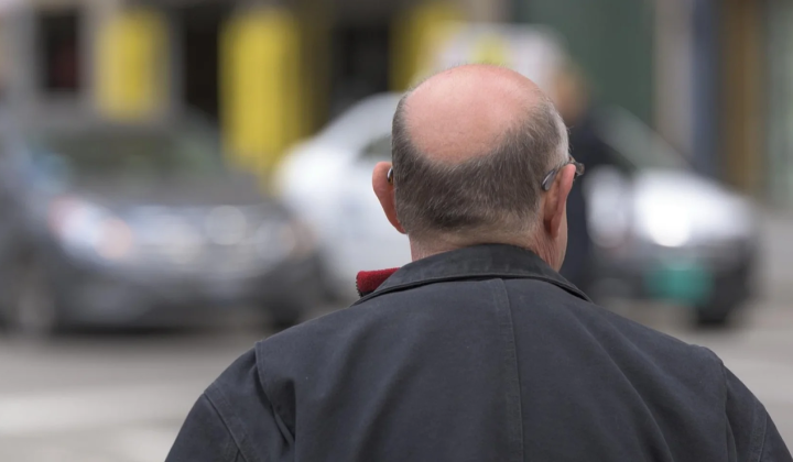 Hair loss remedy - 80% success rate