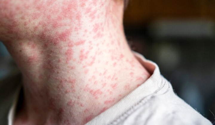 Американці не довіряють адміністрації Трампа у боротьбі зі спалахом кору